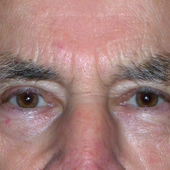 Eyelid lift (Blepharoplasty)